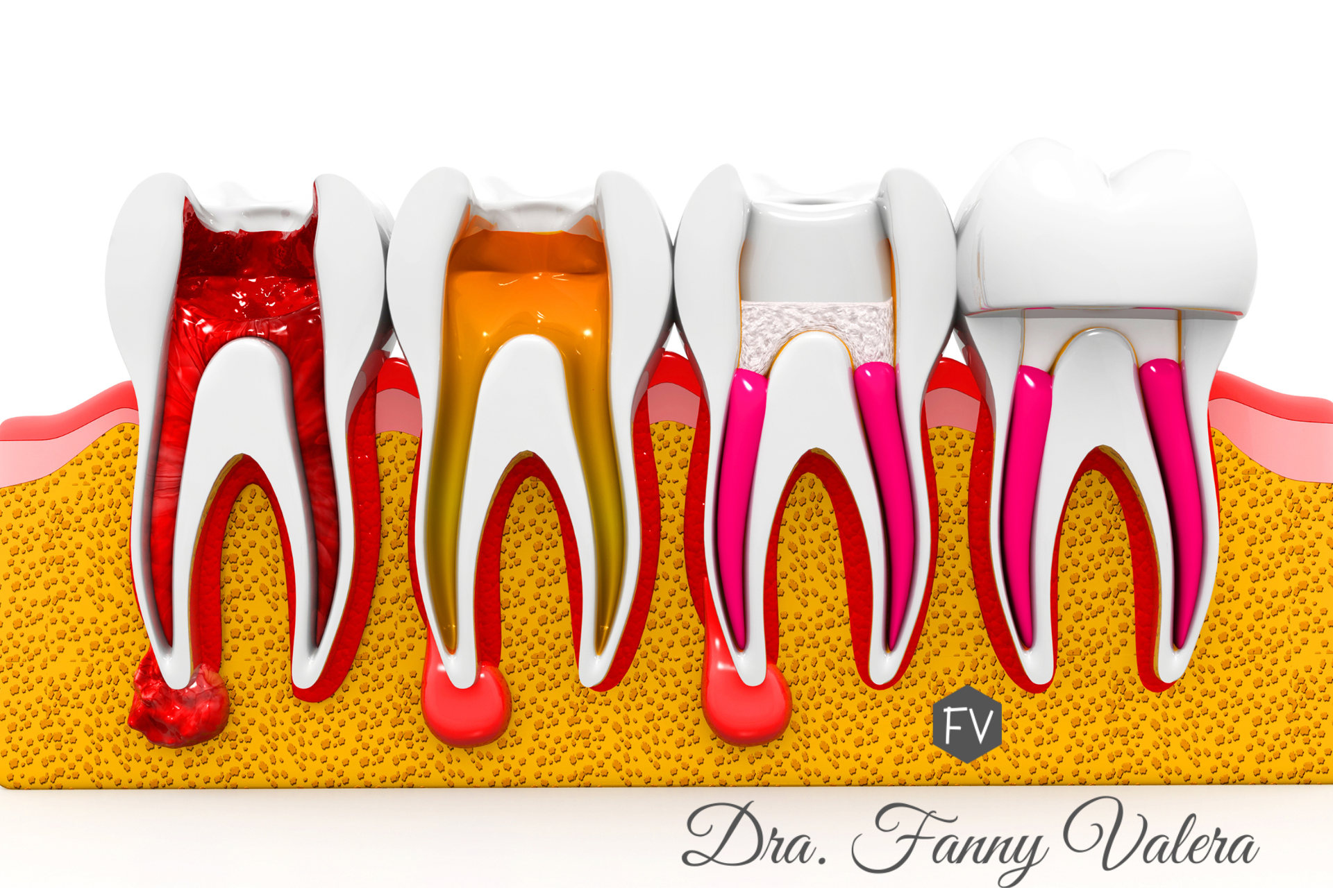 root canal Cartagena, endodontic treatment Colombia, tooth pain relief Cartagena, save infected tooth Cartagena, dental emergency care for international patients, dental prices, Root canal prices