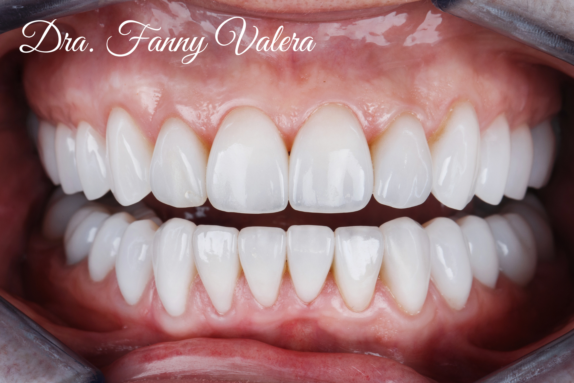 porcelain veneers, composite veneers, smile design, smile makoever cartagena dental clinic