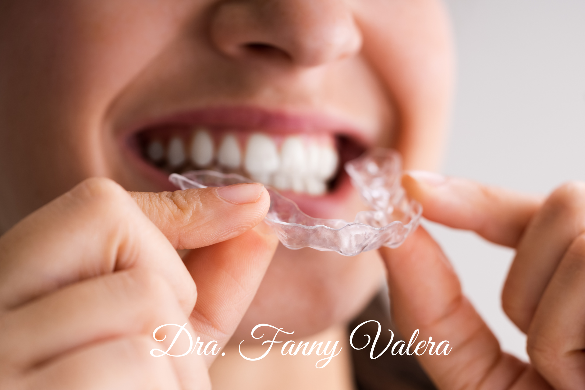 clear retainers, clear retainers prices cartagena, clear retaines colombia