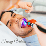 dental treatmenet composite fillings, smile makeover cartagena, dental clinic, dental fillings prices cartagena