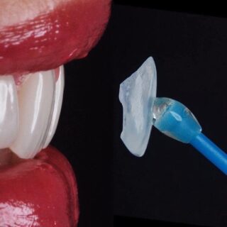 portfolio veneers, veneers, best veneers cartagena