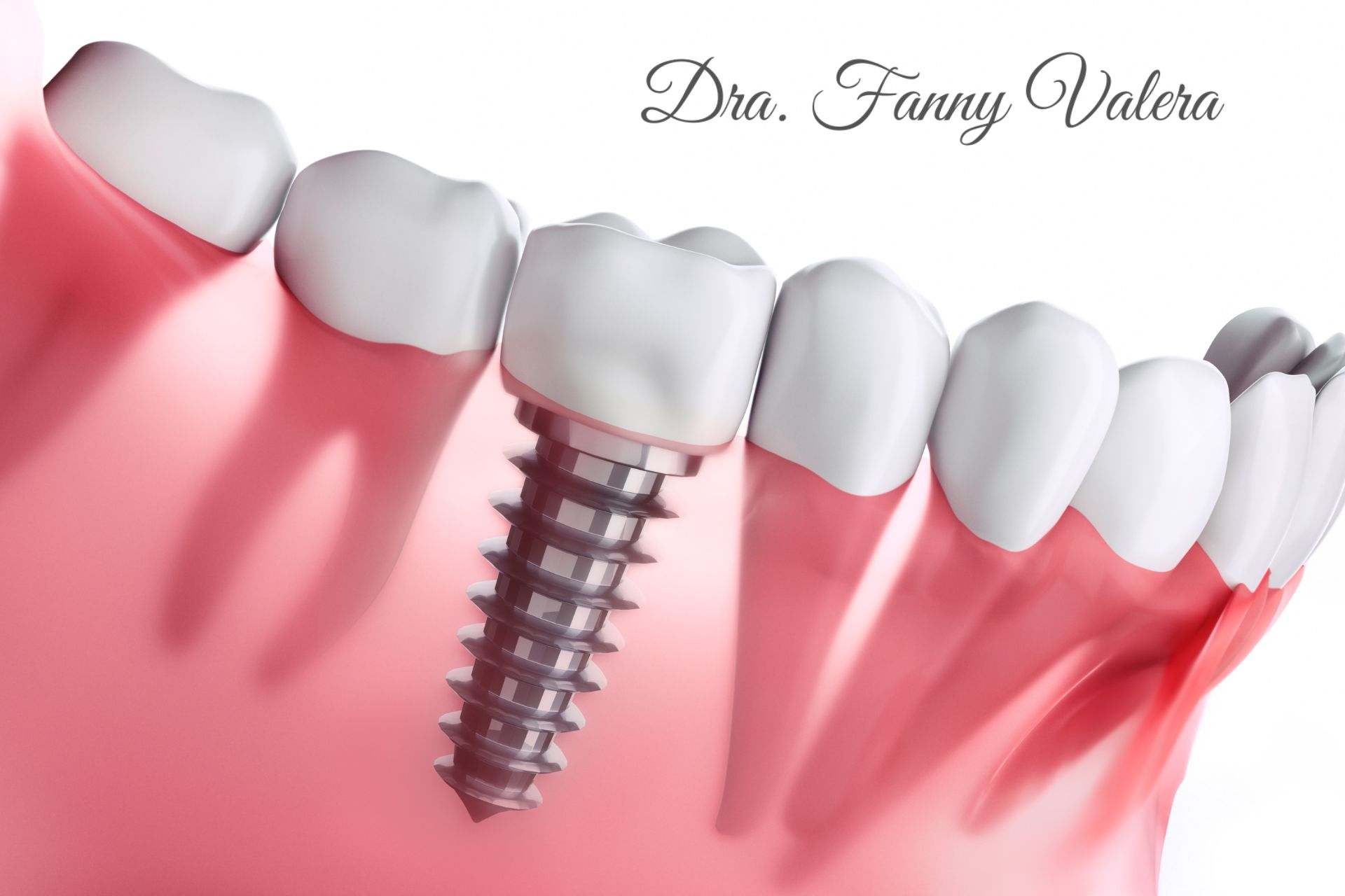 paquete smile makeover con implantes, smile makeover with implans package cartagena prices